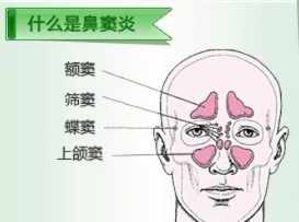 佛法鼻窦炎是什么因 佛教鼻炎