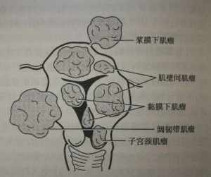 佛教对子宫肌瘤看法 佛教对子宫肌瘤看法是什么