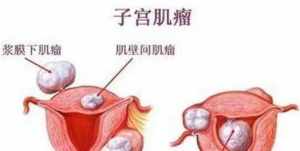 佛讲子宫肌瘤 佛教对子宫肌瘤看法