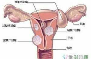 学佛网子宫肌瘤是什么果报 佛教如何看待子宫肌瘤