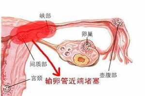 佛法输卵管堵塞的因果 输卵管堵塞怎么可以疏通