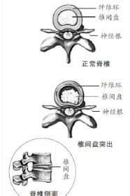 腰间盘突出佛教业报 腰间盘突出佛法